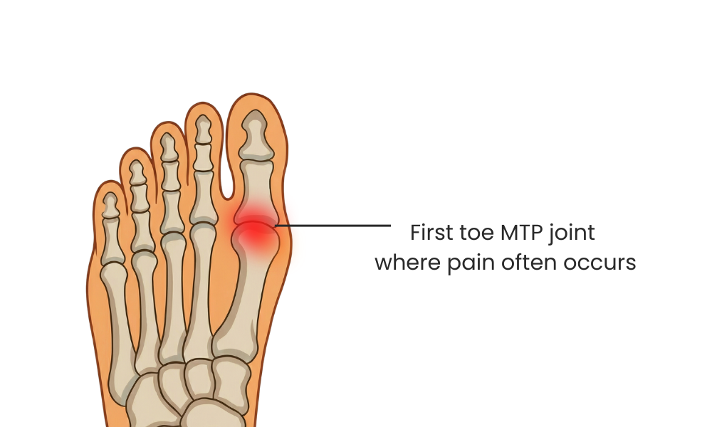 What Causes Pain in the Ball of the Foot?