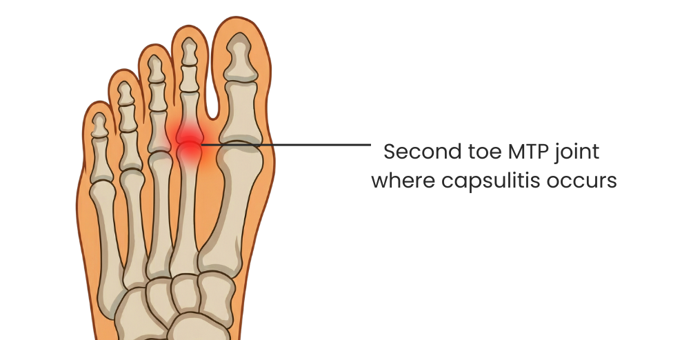 Capsulitis diagram showing inflammation at the second toe joint
